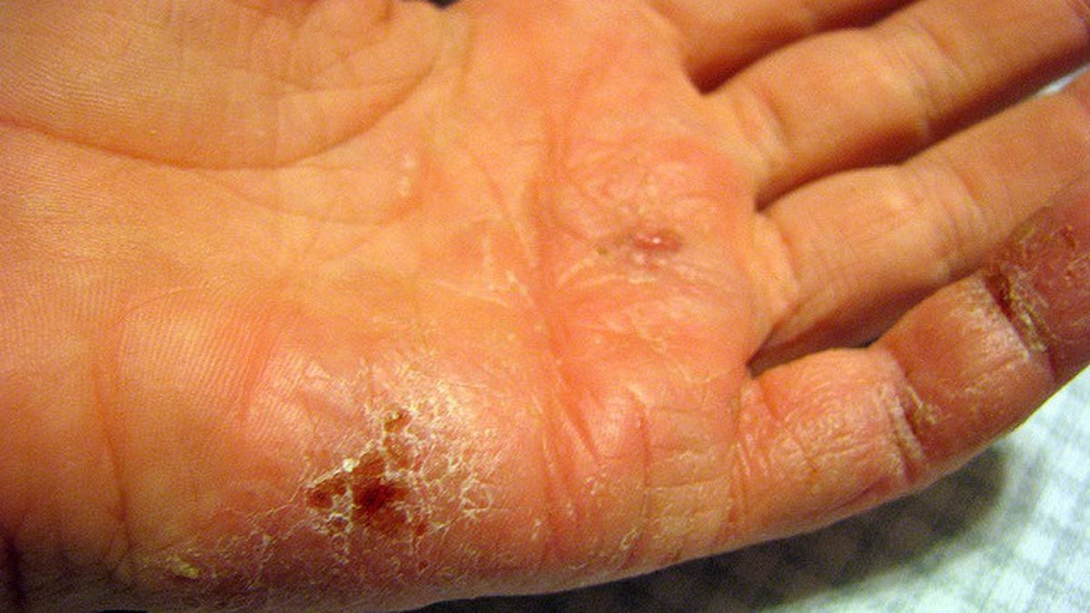 How to prevent dry, cracked hands this winter